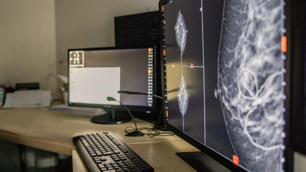 Η τεχνητή νοημοσύνη στην διάγνωση του καρκίνου του μαστού